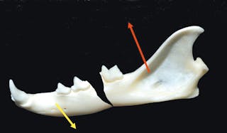 Figure 3. Fracture of the body of the mandible; the yellow arrow shows the direction of pull by muscles that open the jaw; the red arrow shows the direction of pull by muscles that close the jaw. Gaping of the fracture line and poor alignment. 
